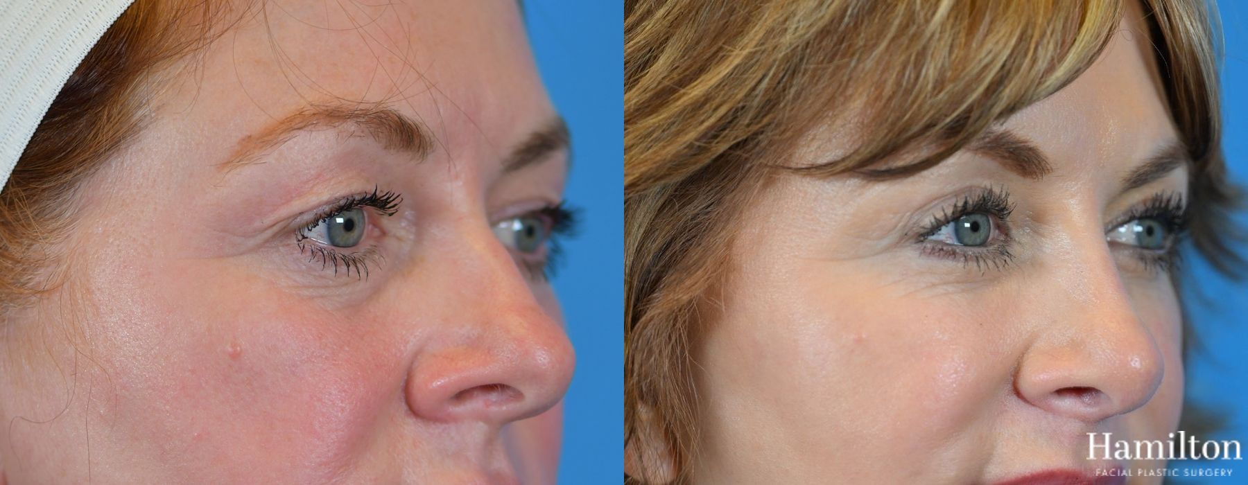Before and after Blepharoplasty case 37277