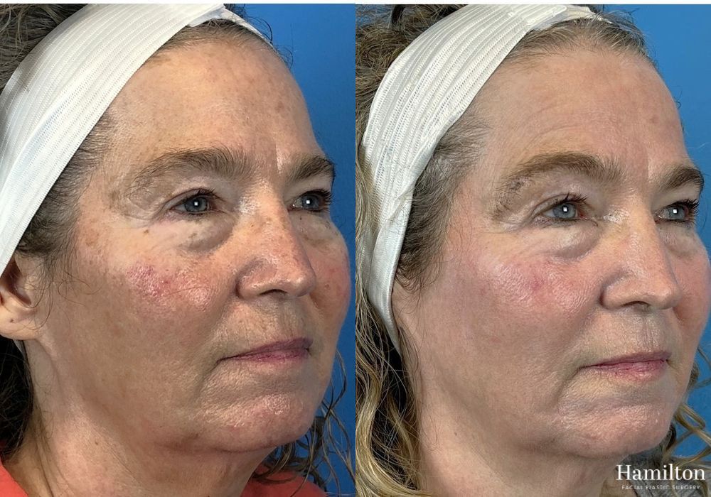 Before and after Laser - HALO case 37362