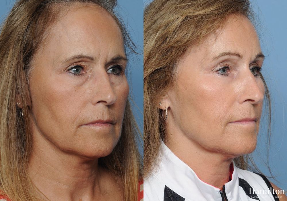 Before and after Brow Lift case 37225 - Angle 3