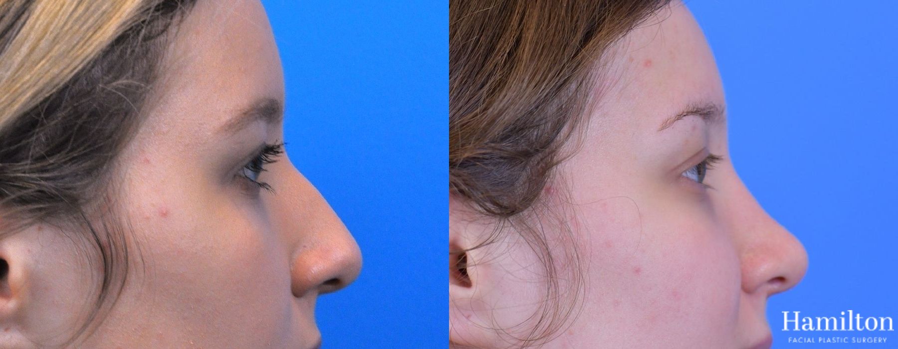 Before and after Rhinoplasty case 37269