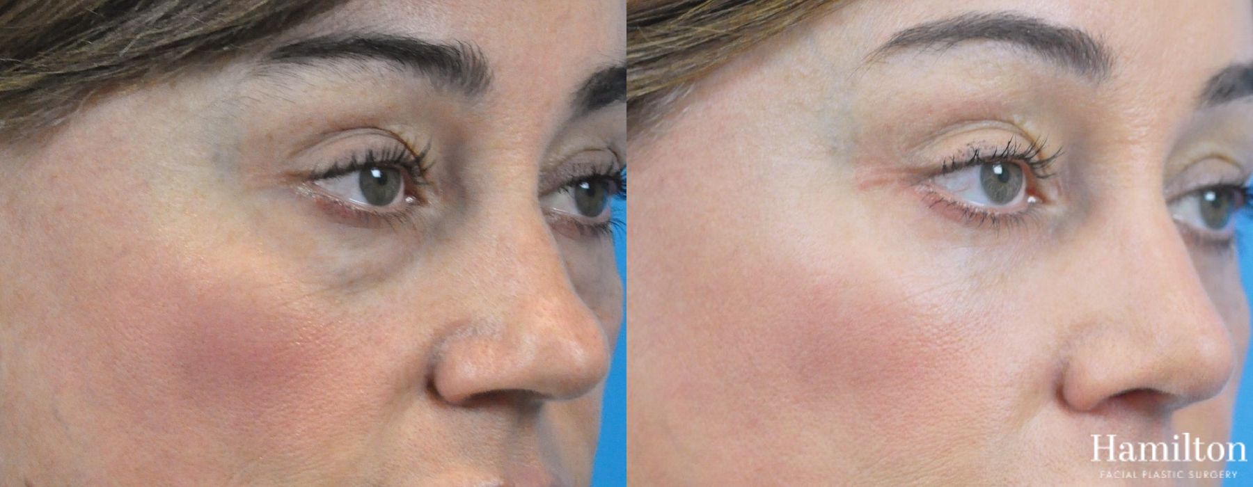 Before and after Blepharoplasty case 37285 - Angle 2