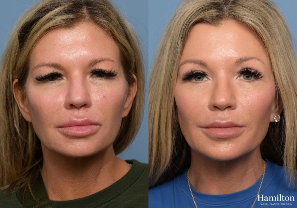 Before and after Brow Lift case 37111