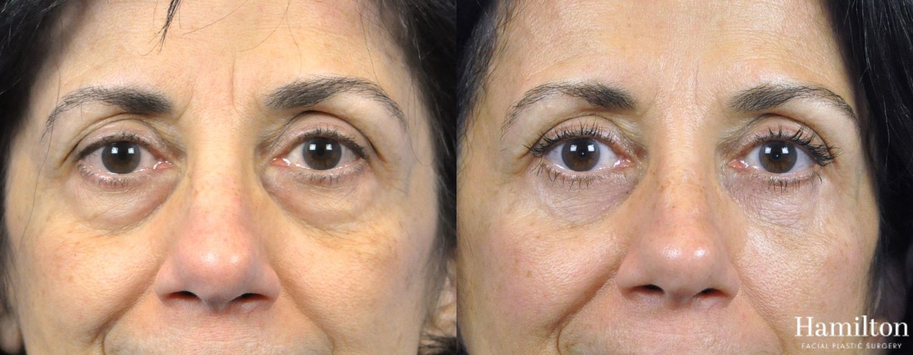 Before and after Blepharoplasty case 37262 - Angle 3