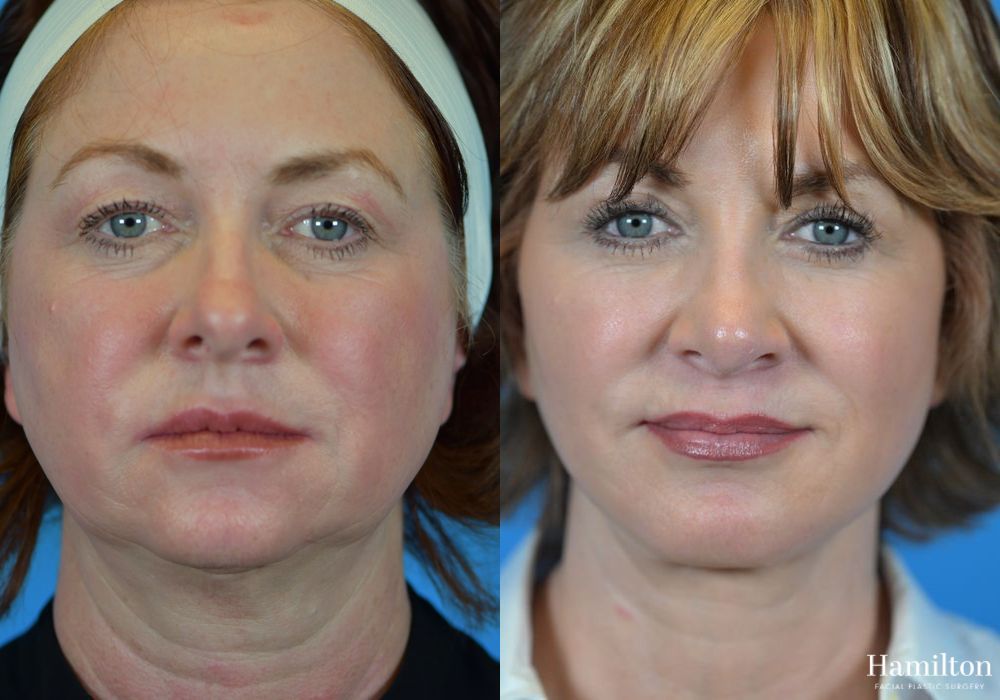 Before and after Neck Rejuvenation case 37168 - Angle 2