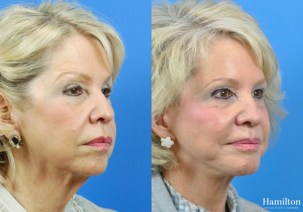Before and after Facelift case 37314 - Angle 2