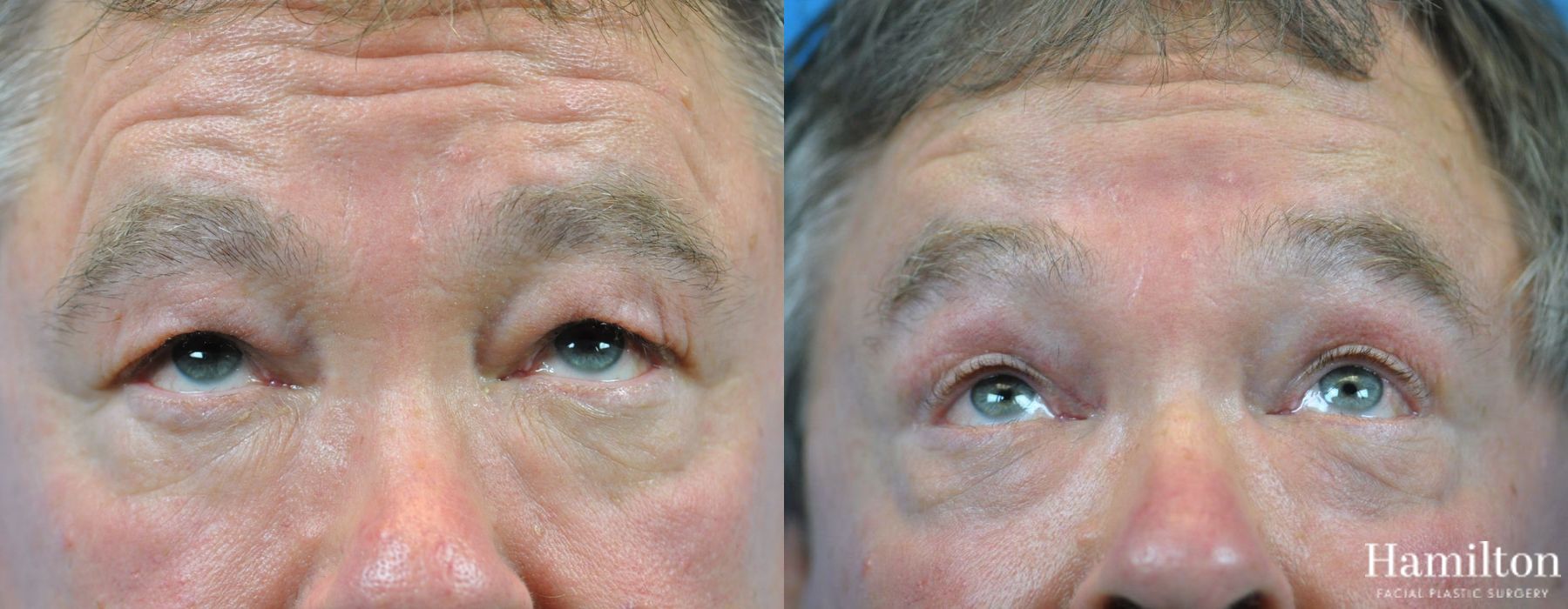 Before and after Blepharoplasty case 37319 - Angle 4