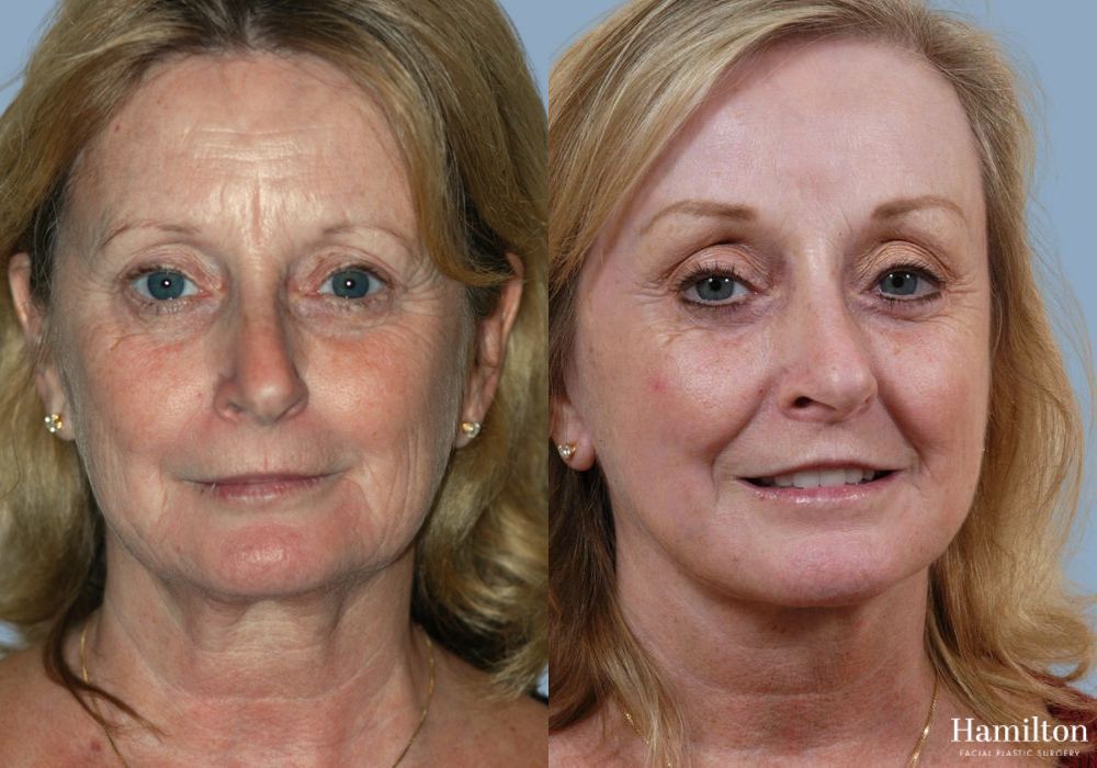 Before and after Laser - CO2 case 37124