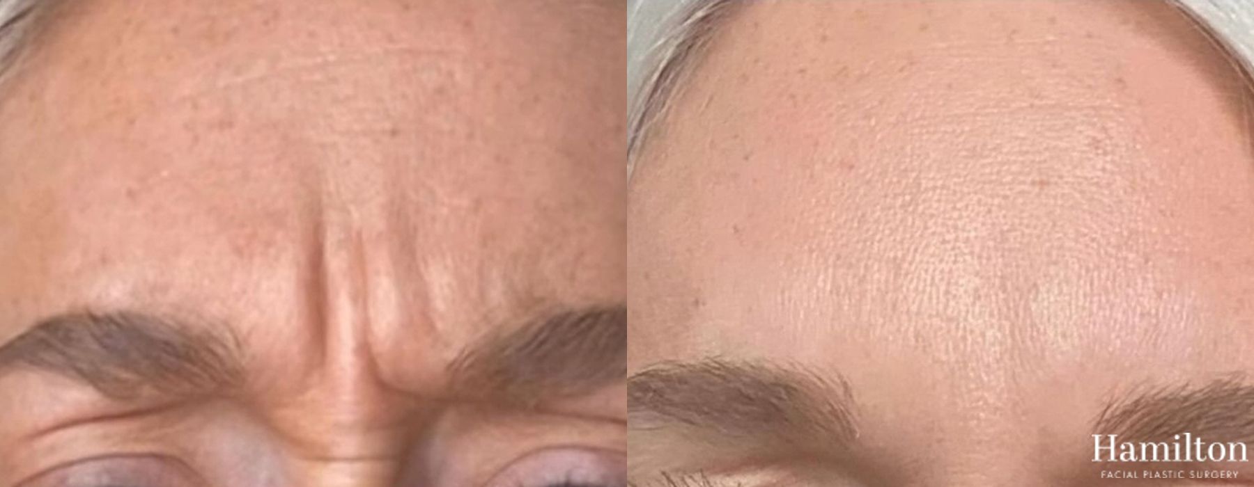 Before and after Neurotoxins/BOTOX case 37082 - Angle 2