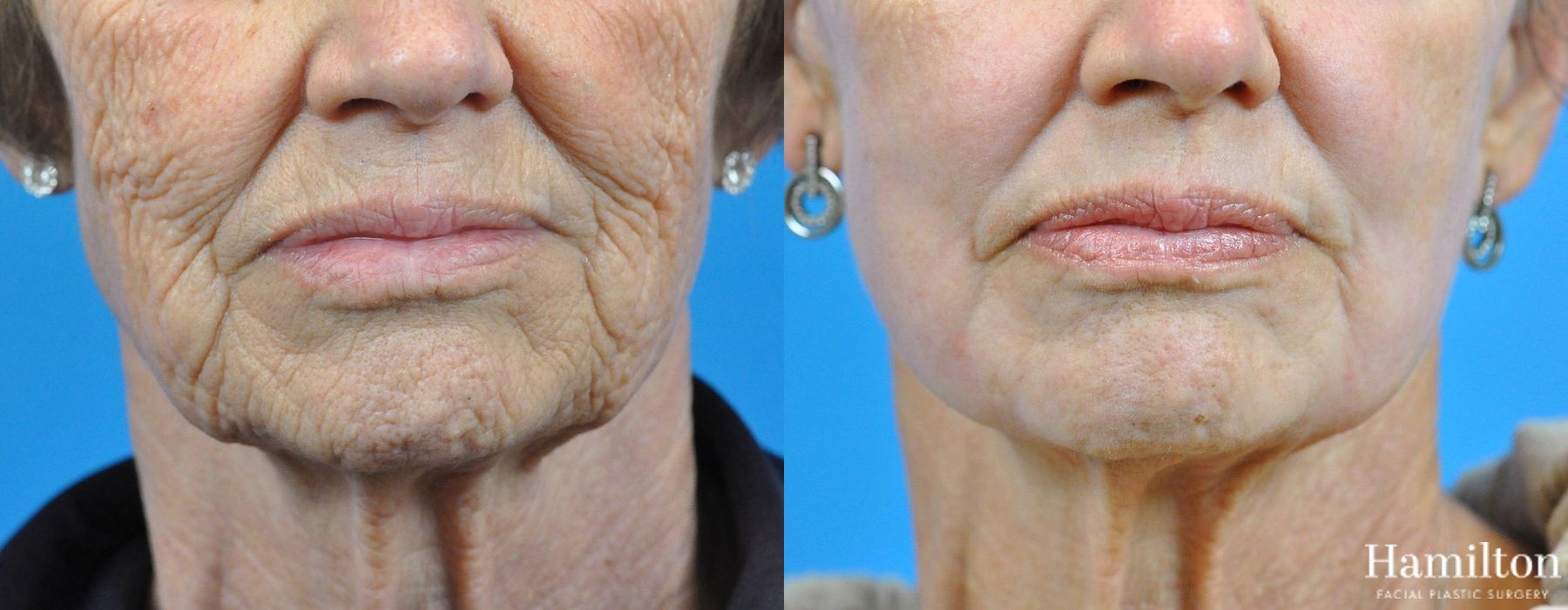 Before and after Laser - CO2 case 37170 - Angle 2