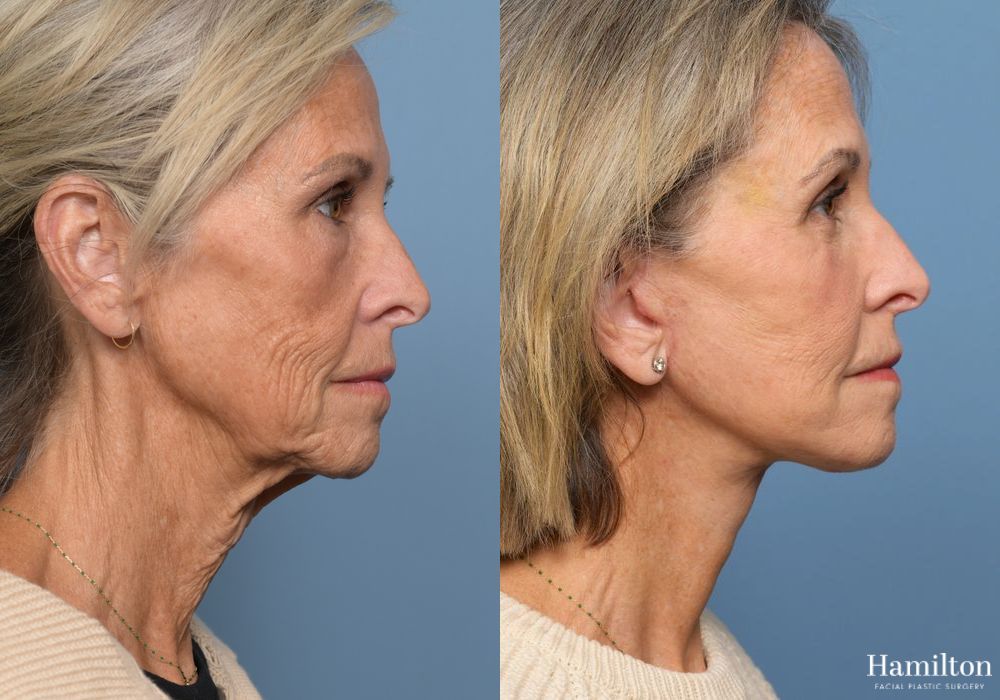 Before and after Facelift case 37219 - Angle 3