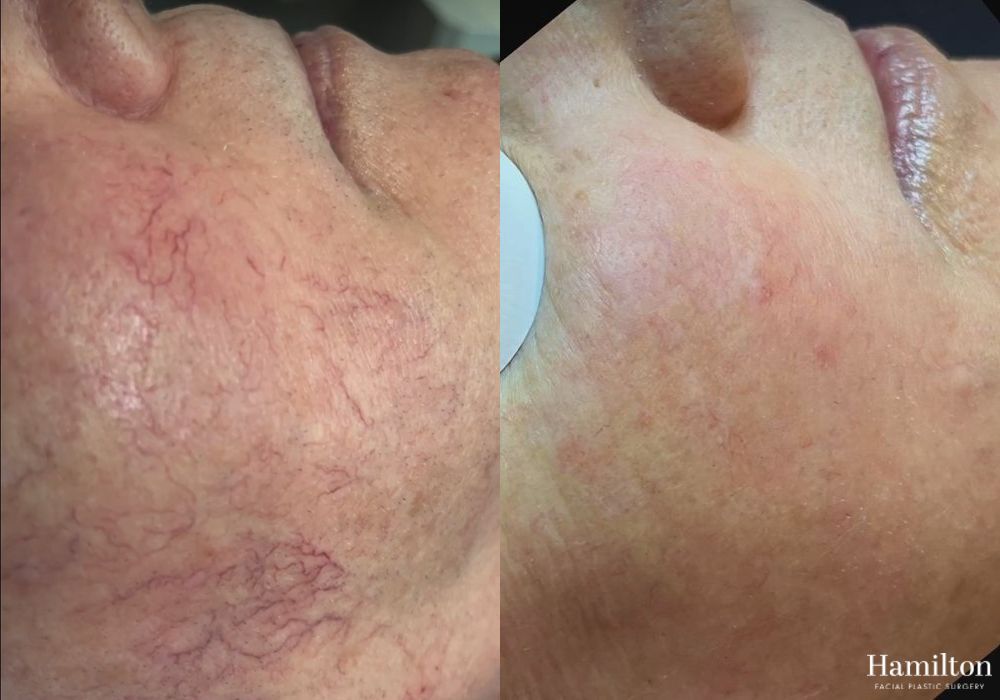 Before and after Laser - Broad Band Light (BBL) case 37163