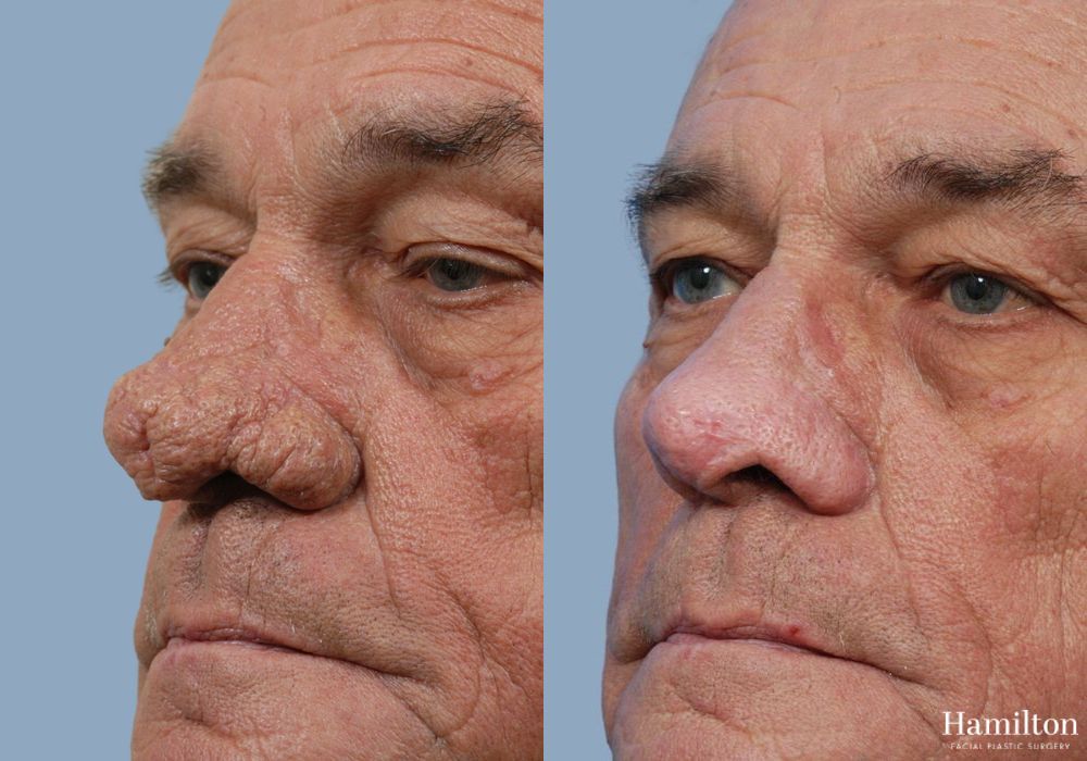 Before and after Rhinophyma case 37343