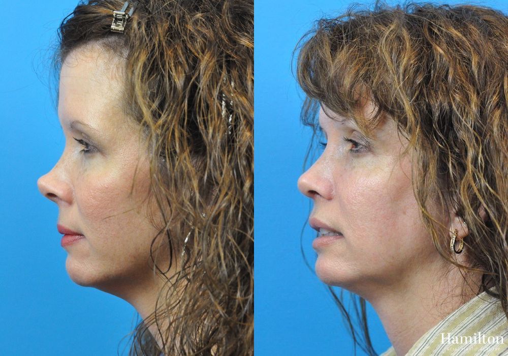 Before and after Rhinoplasty case 37292