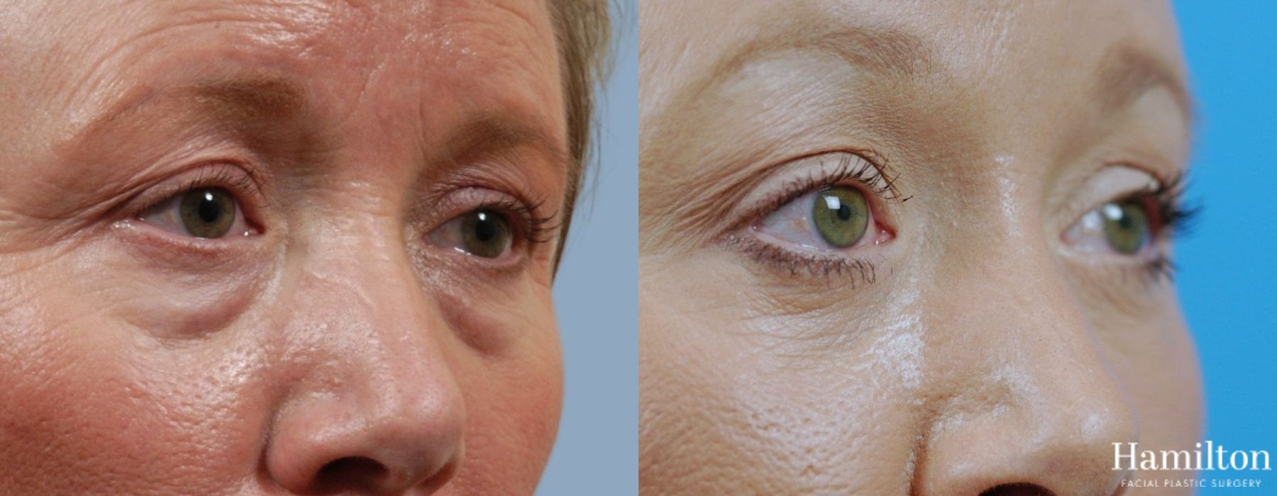 Before and after Blepharoplasty case 37284 - Angle 2