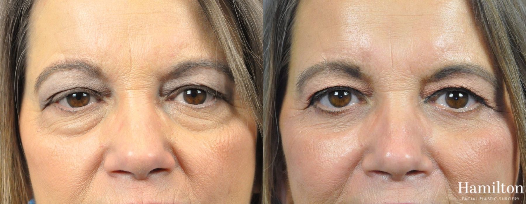 Before and after Blepharoplasty case 37226 - Angle 2