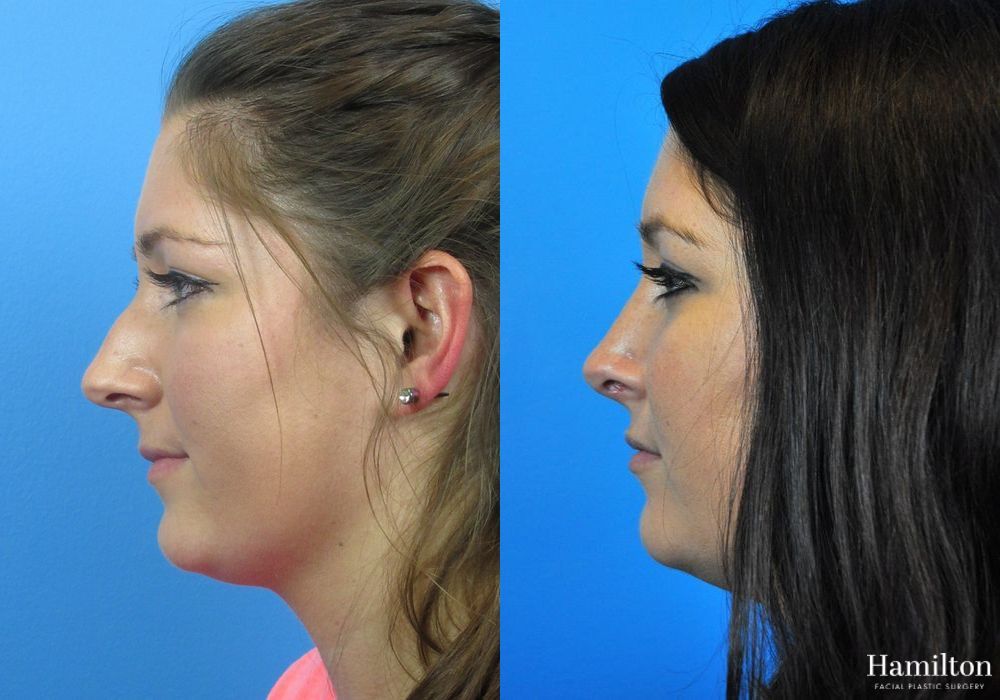 Before and after Rhinoplasty case 37356 - Angle 2