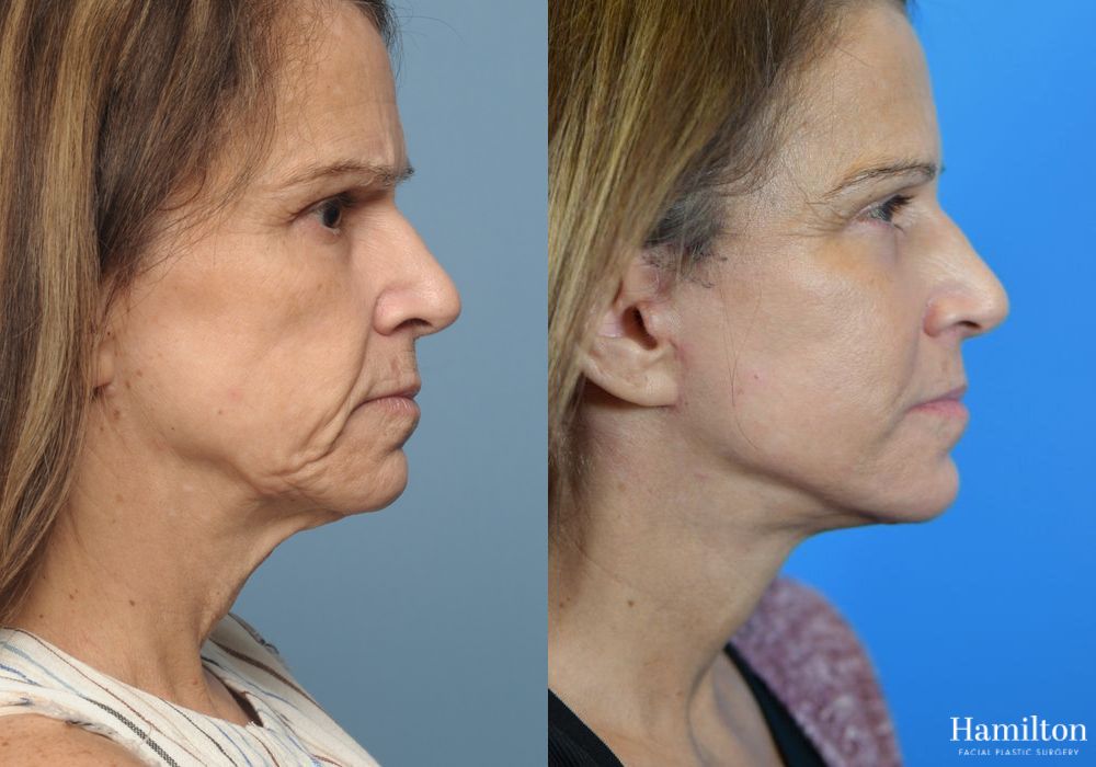Before and after Facelift case 37273