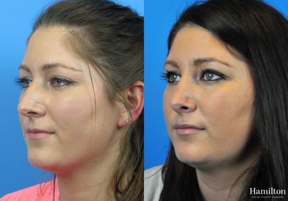Before and after Rhinoplasty case 37356 - Angle 4