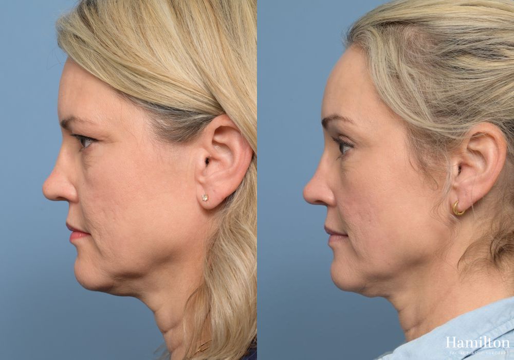 Before and after Brow Lift case 37117 - Angle 4