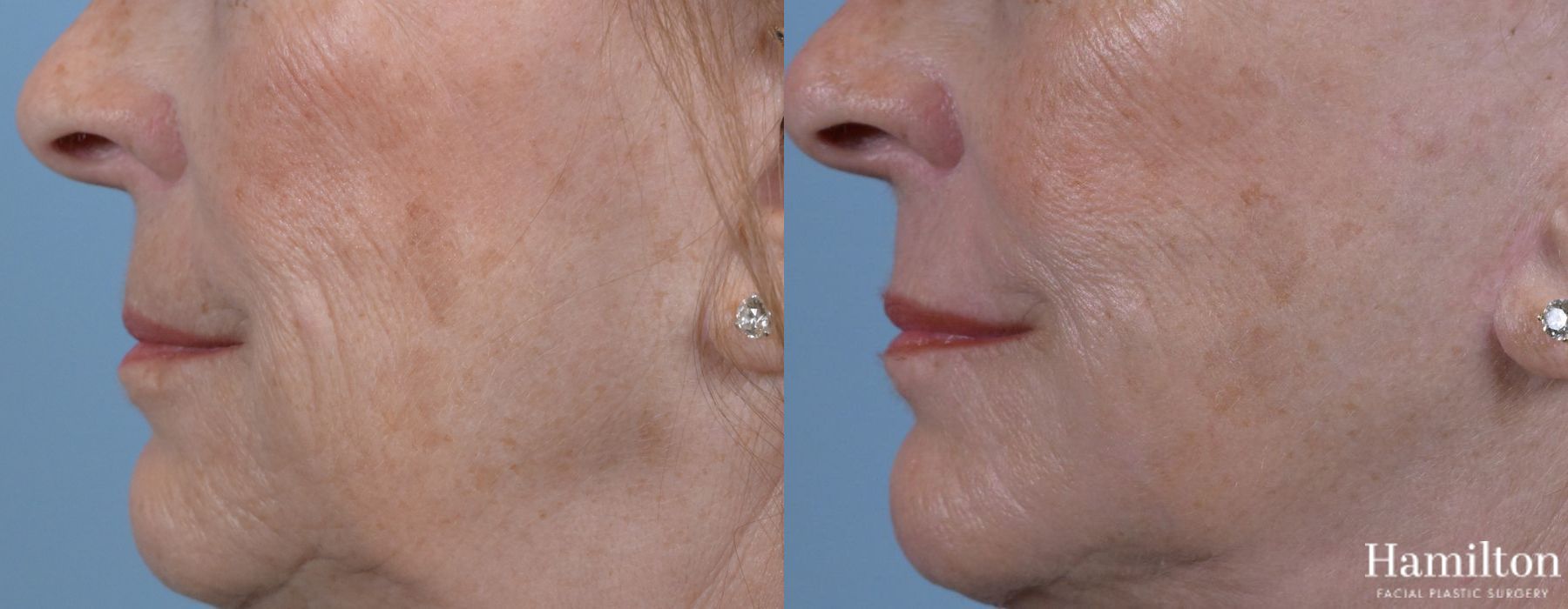 Before and after Laser - Sciton case 37118 - Angle 5