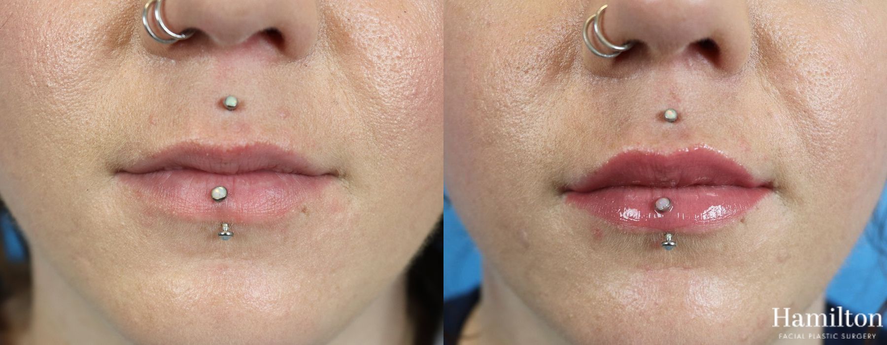 Before and after Lip Enhancement case 37190