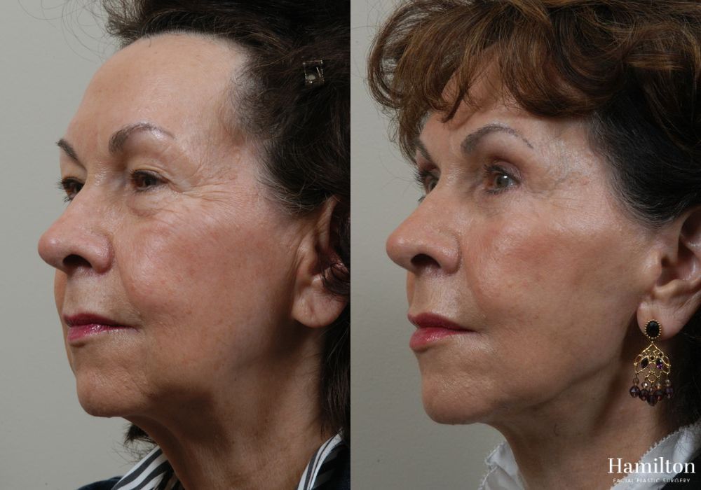 Before and after Facelift case 37326 - Angle 2