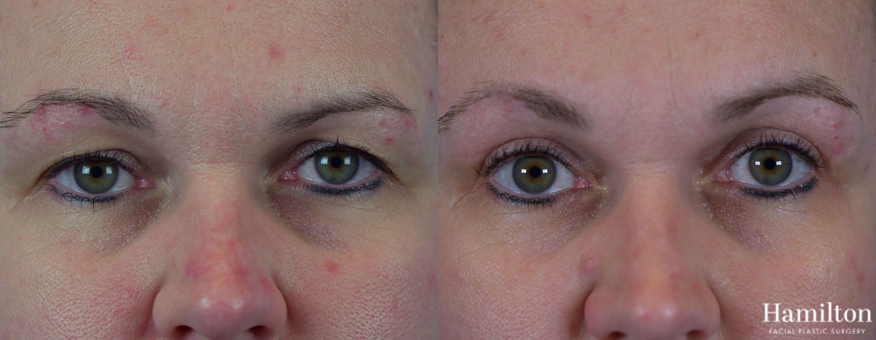 Before and after Blepharoplasty case 37304