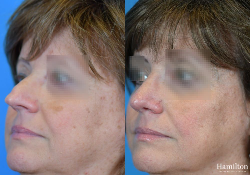 Before and after Rhinoplasty case 37337 - Angle 4