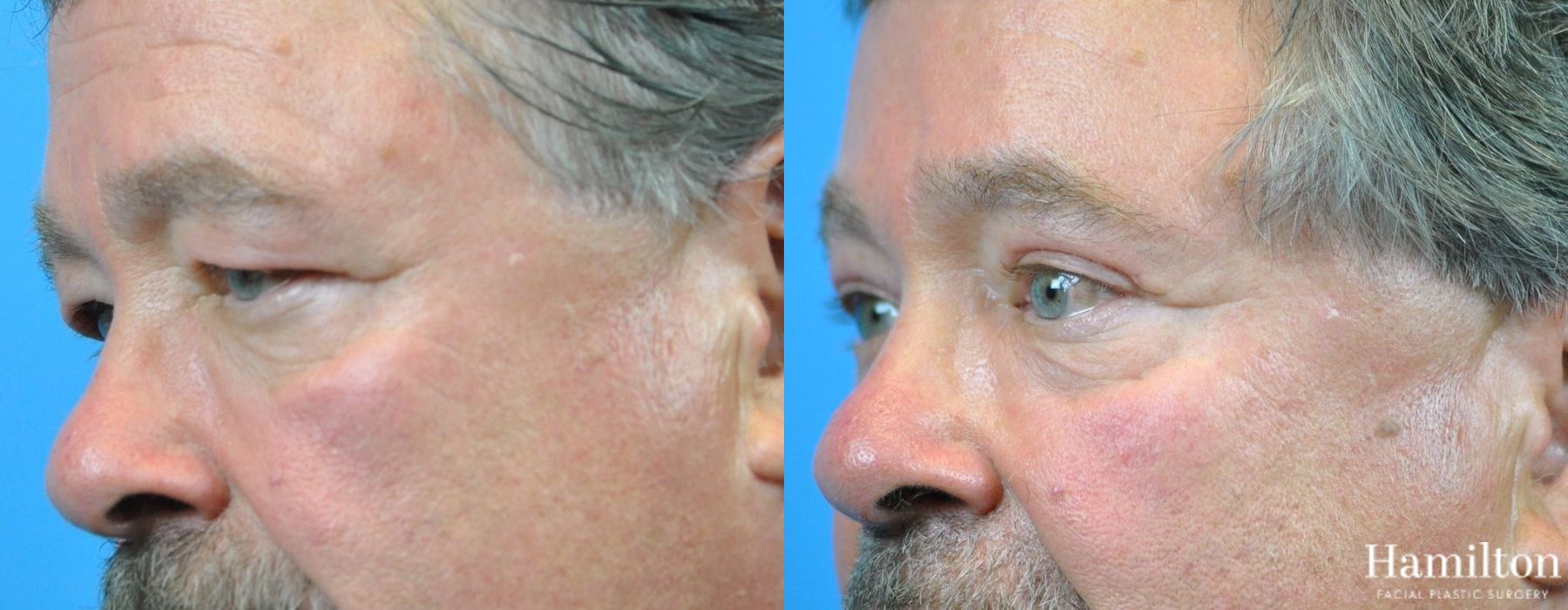 Before and after Blepharoplasty case 37319 - Angle 2