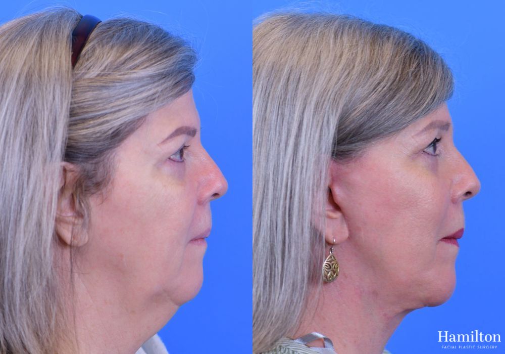 Before and after Facelift case 37278