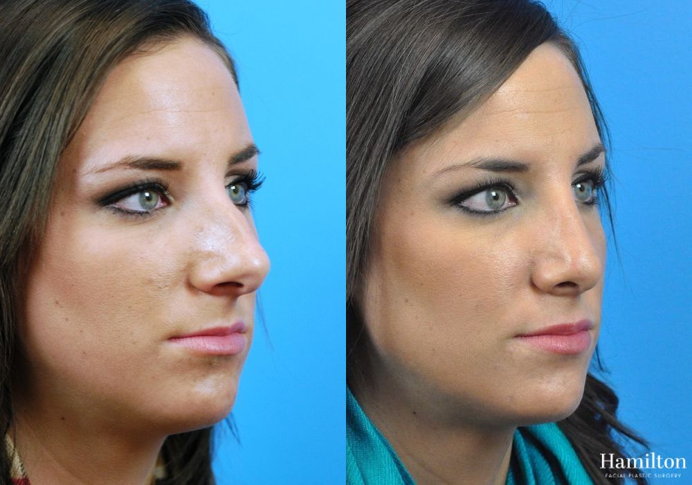 Before and after Rhinoplasty case 37287 - Angle 3