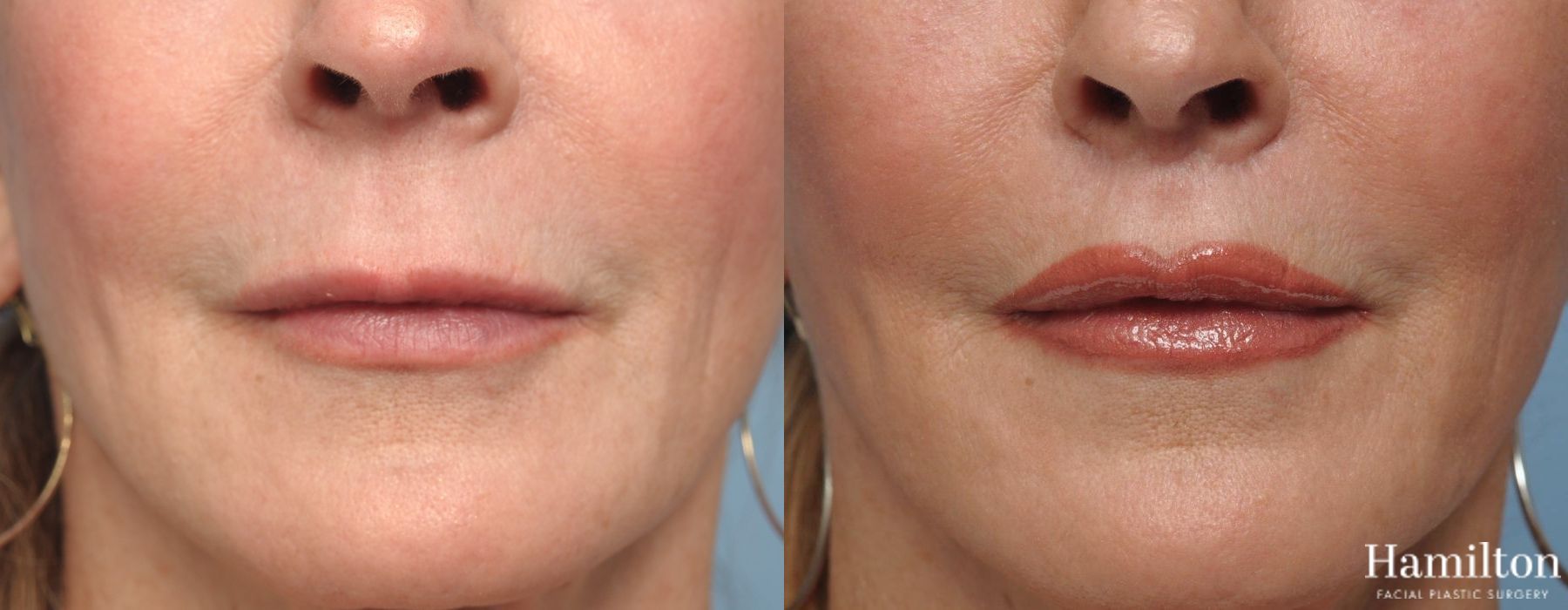 Before and after Lip Lift case 37103