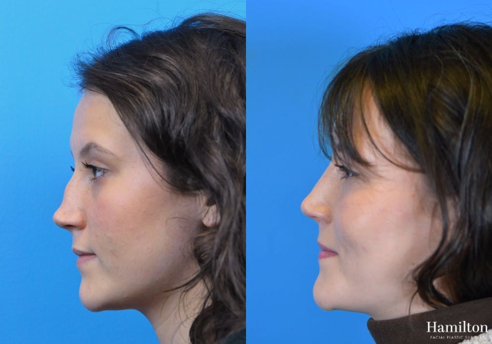 Before and after Rhinoplasty case 37275