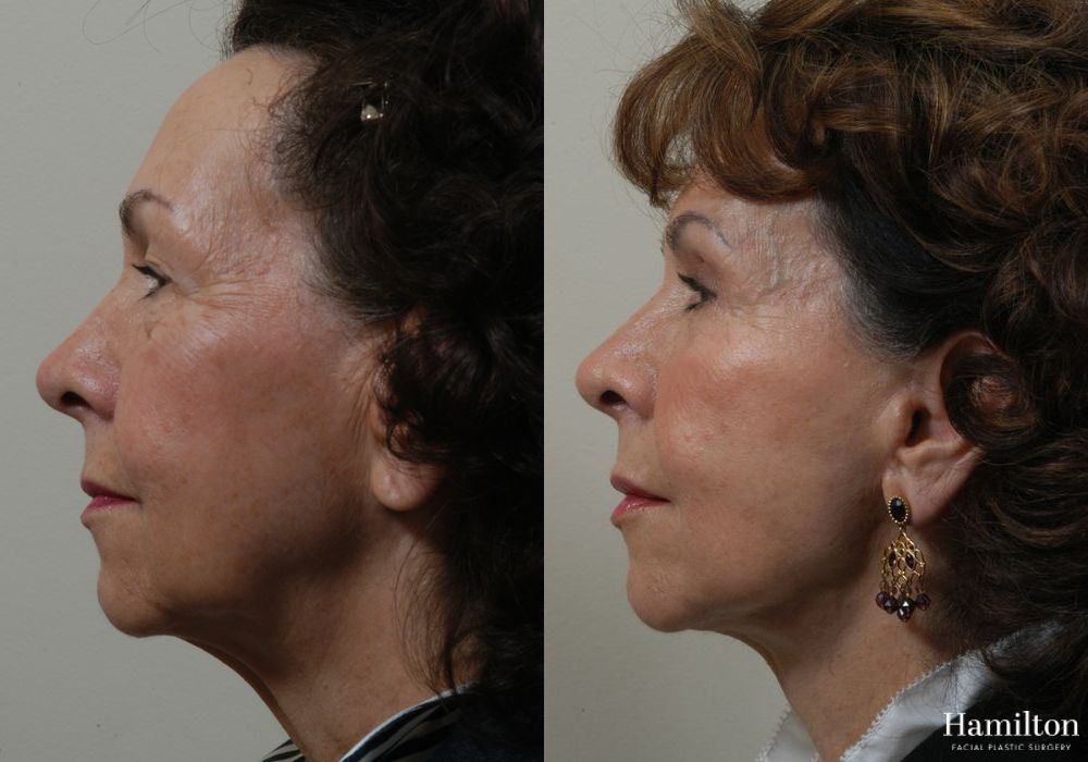 Before and after Facelift case 37326 - Angle 3