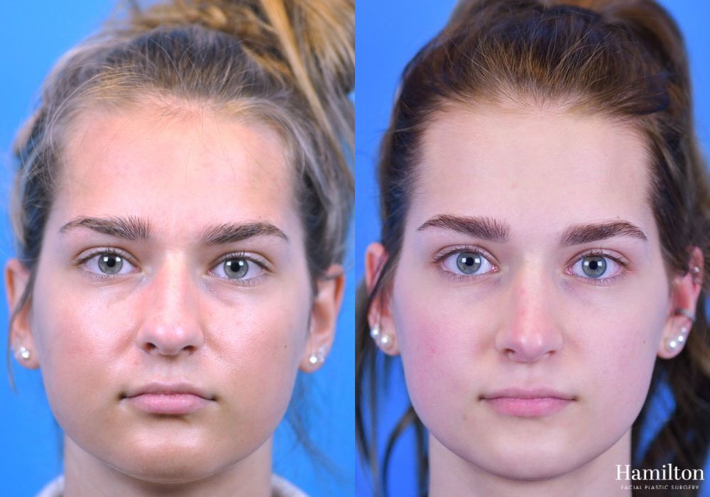 Before and after Rhinoplasty case 37251 - Angle 5