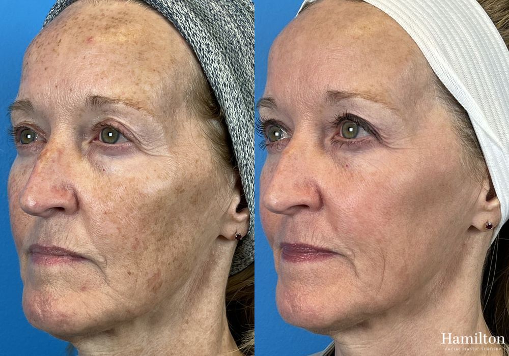 Before and after Laser - Broad Band Light (BBL) case 37099 - Angle 2