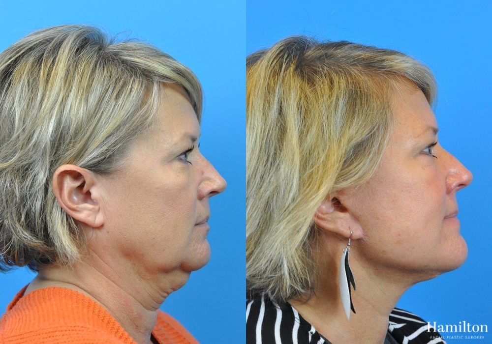 Before and after Neck Rejuvenation case 37172 - Angle 2