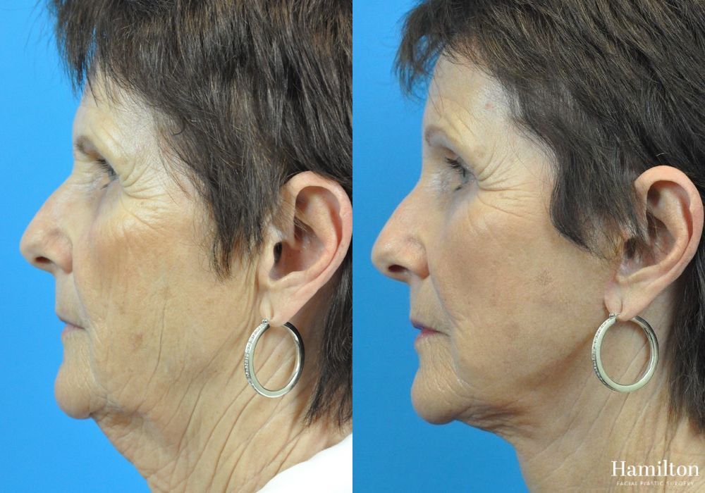 Before and after Facelift case 37301