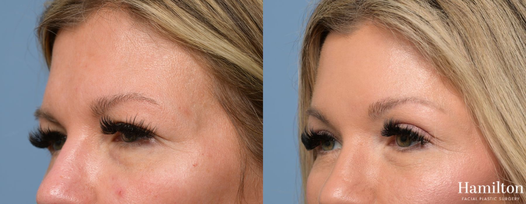 Before and after Blepharoplasty case 37156 - Angle 3