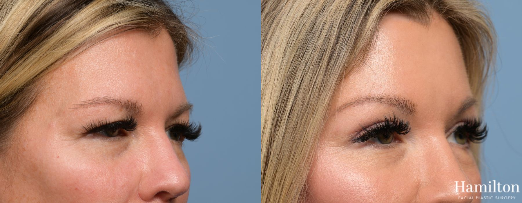Before and after Blepharoplasty case 37156 - Angle 2