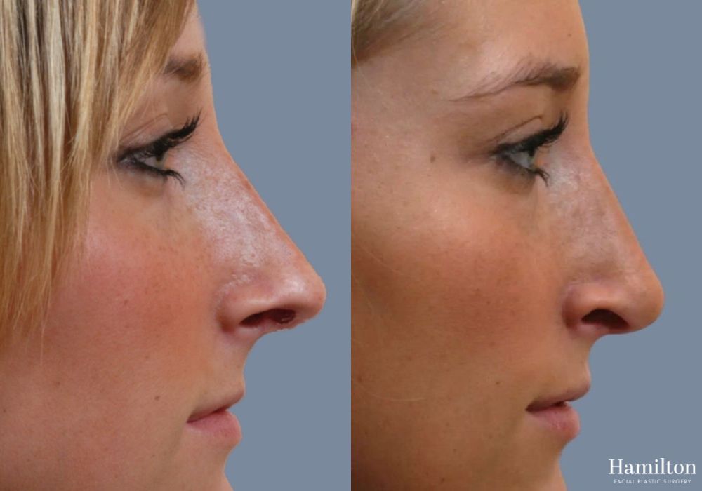 Before and after Rhinoplasty case 37211 - Angle 4