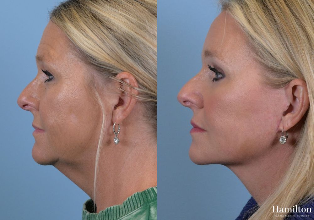 Before and after Brow Lift case 37178