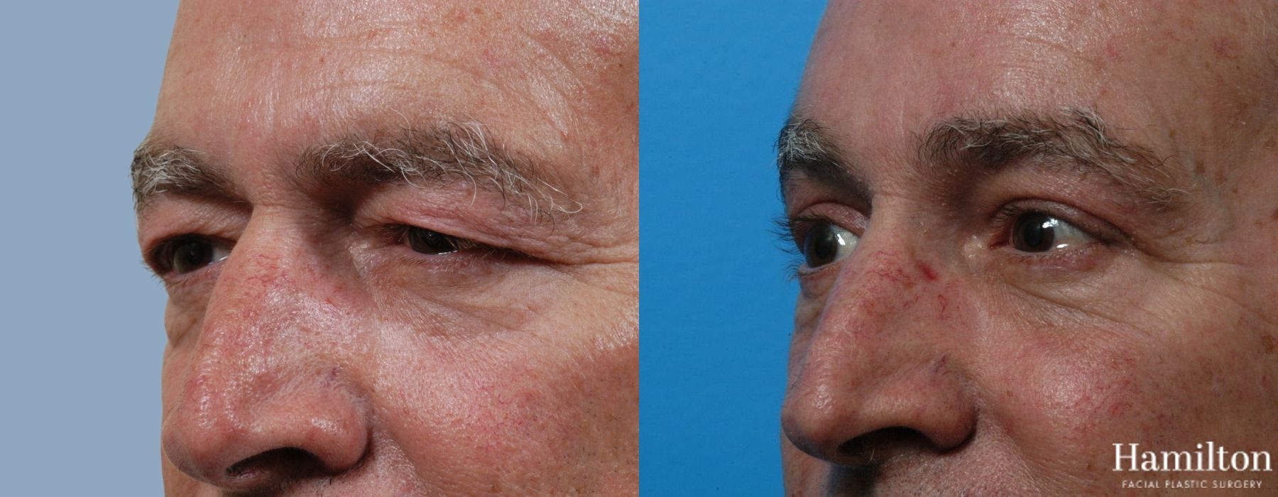 Before and after Blepharoplasty case 37280 - Angle 2