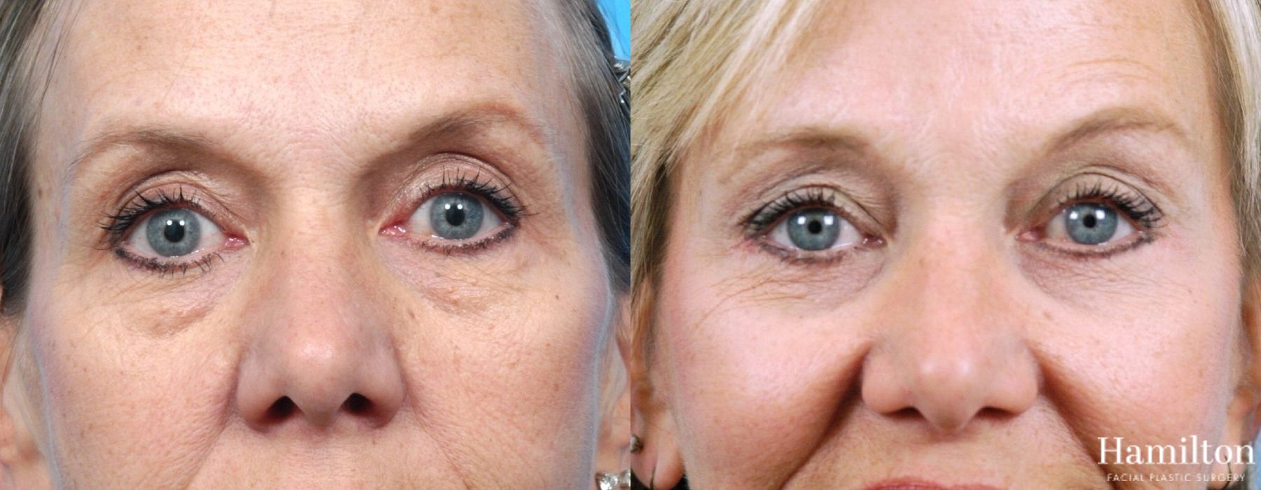 Before and after Blepharoplasty case 37216