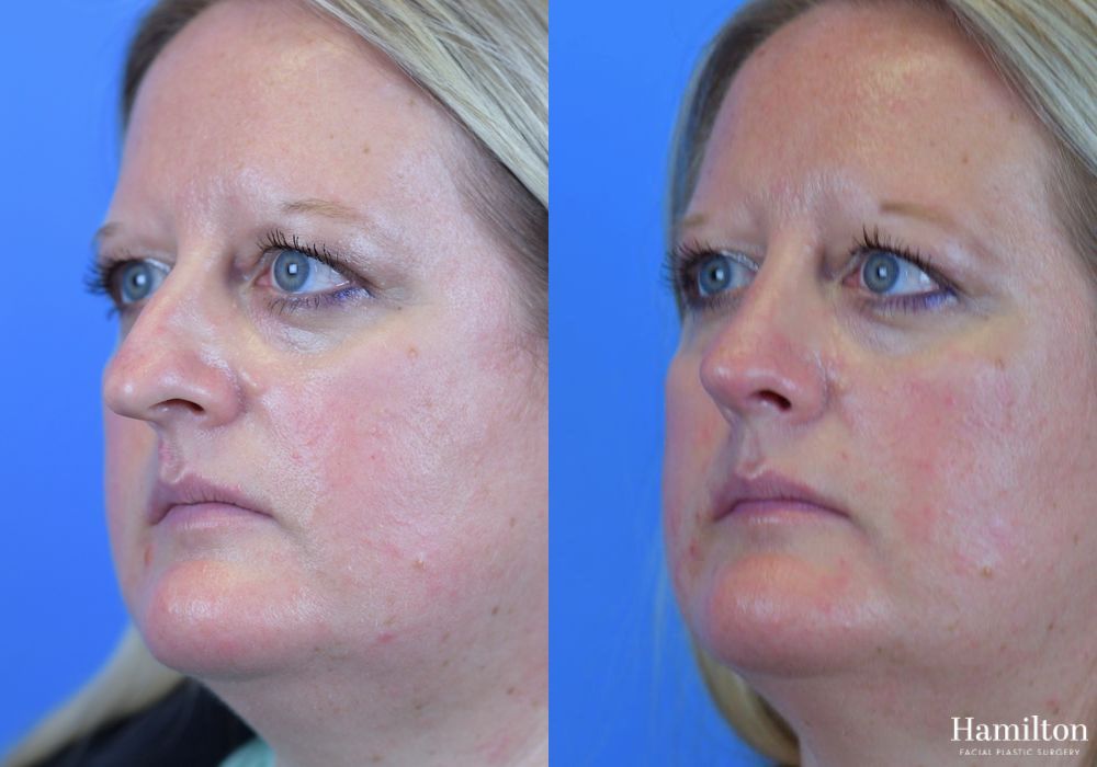 Before and after Rhinoplasty case 37311 - Angle 4