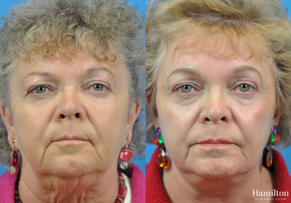 Before and after Laser - CO2 case 37210