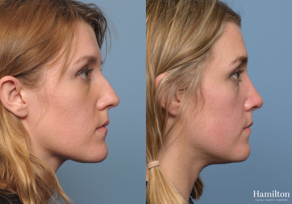 Before and after Rhinoplasty case 37136
