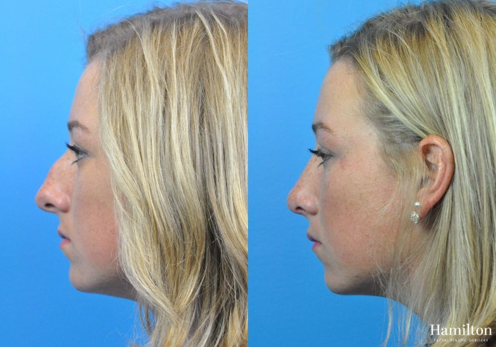 Before and after Rhinoplasty case 37328