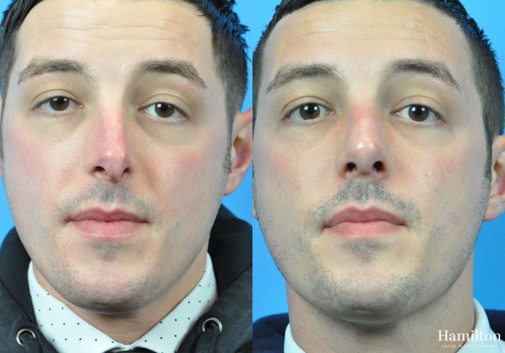 Before and after Rhinoplasty case 37333
