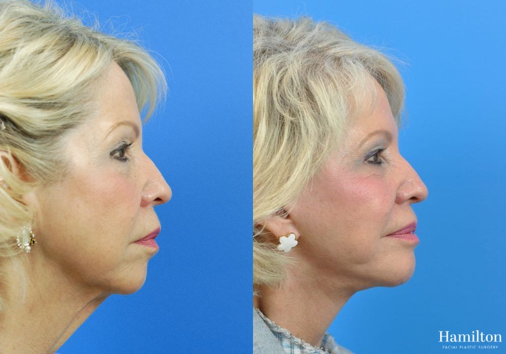 Before and after Chin Augmentation case 37193